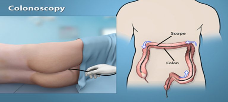 Trusting Singapore’s Experts to Make Your Colonoscopy More Comfortable