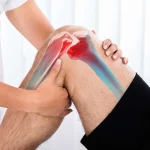 Is Cryotherapy Right for You a Beginners Guide?