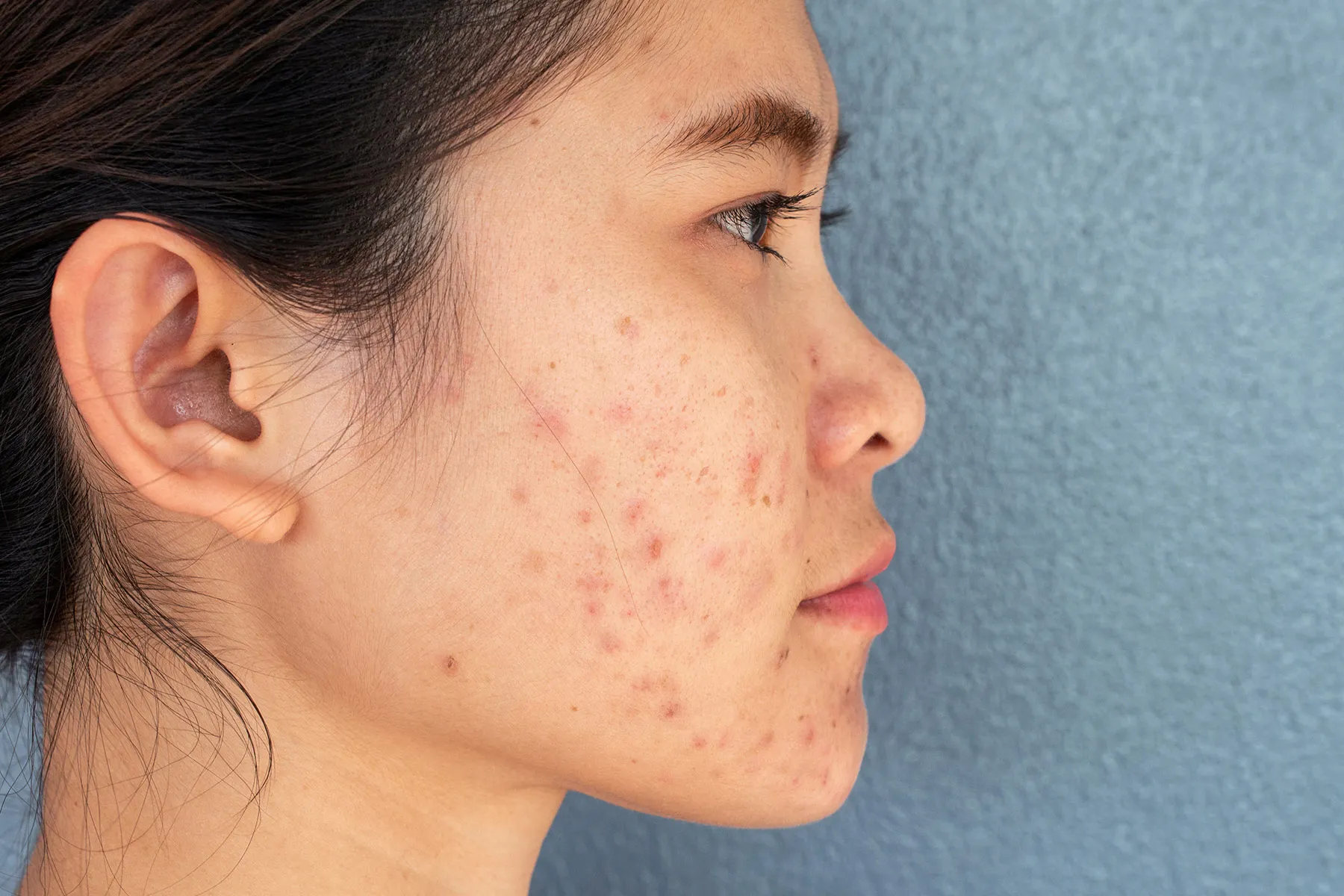 Treating Severe Acne Scars
