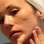 The Role of Dermatologists in Treating Severe Acne Scars