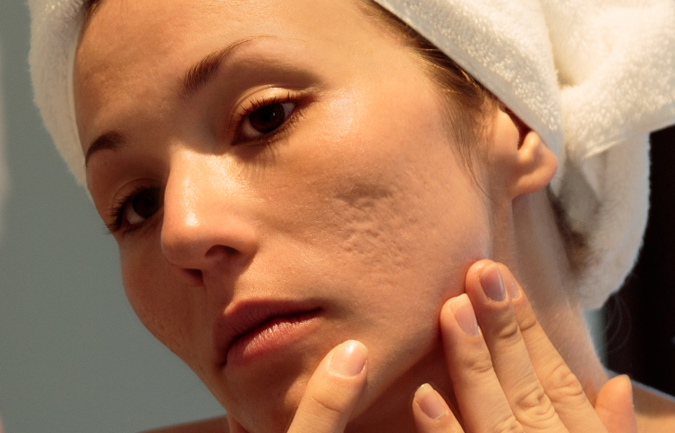 The Role of Dermatologists in Treating Severe Acne Scars