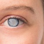 Causes Of Cataracts and Its Solution
